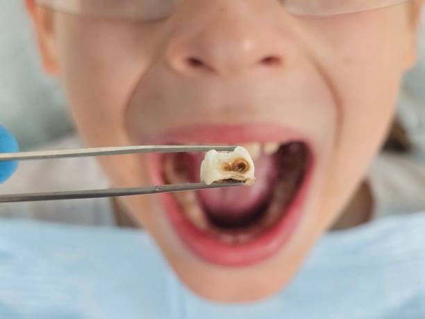 Best Emergency Dental Care for Abscessed Tooth in Port Morris, NJ